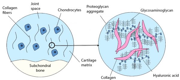 morquio syndrome