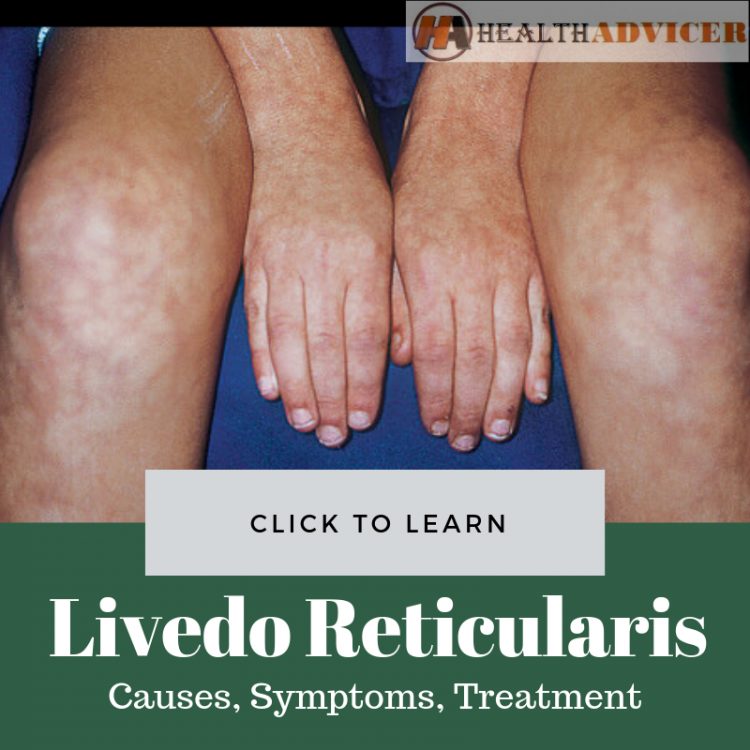 Livedo Reticularis