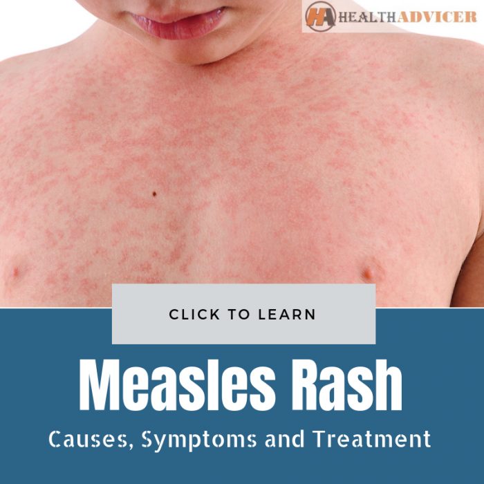 Measles Rash Causes Treatment