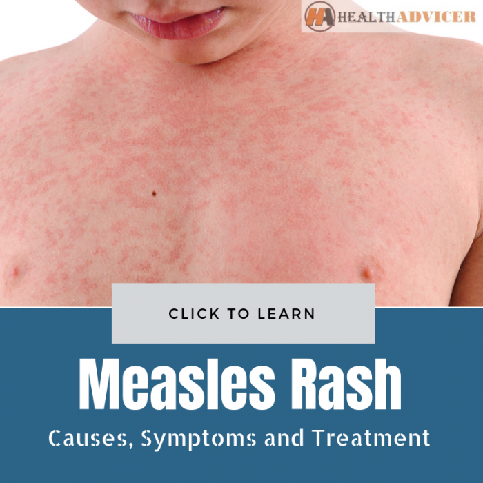 Measles Rash Causes Treatment