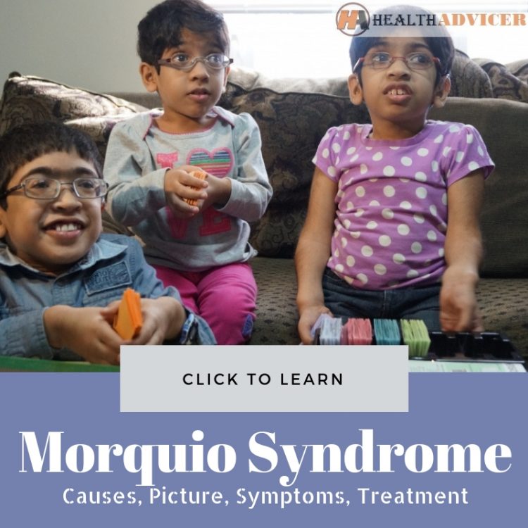 Morquio Syndrome Picture