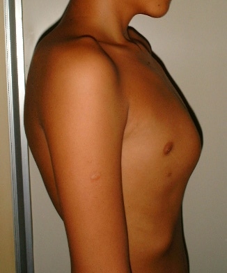 Pectus Carinatum