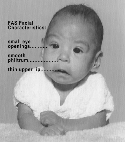 Fetal alcohol syndrome