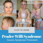 Prader Willi Syndrome Picture