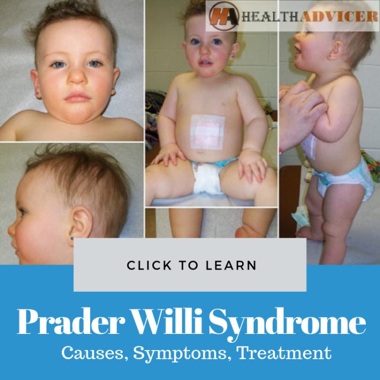 Prader Willi Syndrome Picture