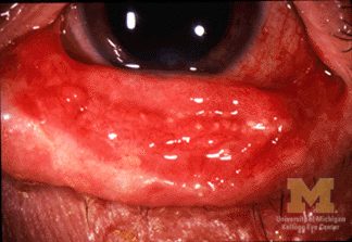 Stevens Johnson syndrome