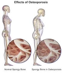 Turners syndrome