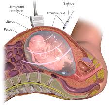 Amniocentesis