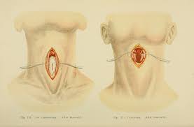 Tracheotomy