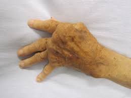 Rheumatoid Arthritis