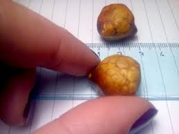 Gallstones