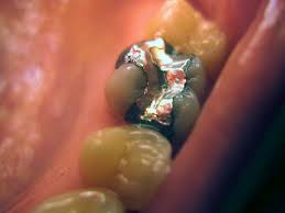 Dental Filling