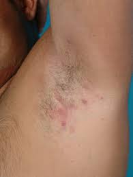 Hidradenitis Suppurativa