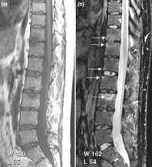 Arthritic Conditions