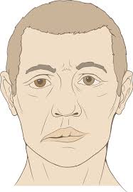 Bell’s palsy