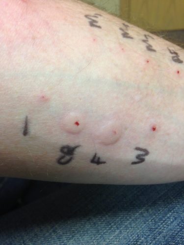 Allergy Test