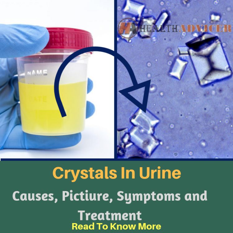 Crystals In Urine