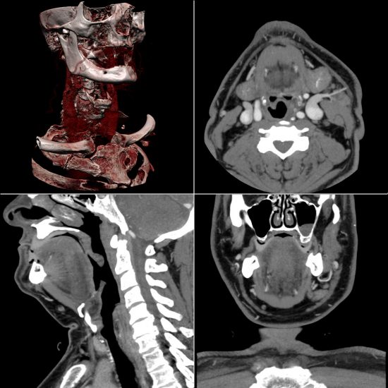 Craniofacial CT Scan