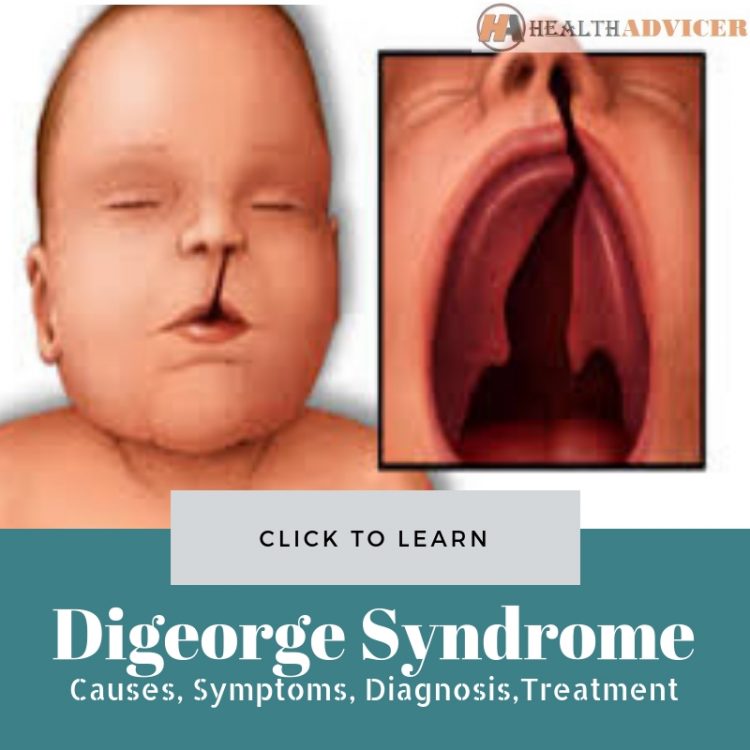 Digeorge Syndrome Picture
