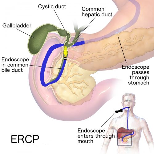 Remove Bile Duct Obstructions