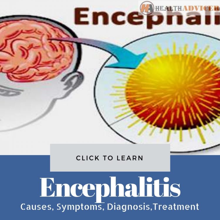 Encephalitis Picture