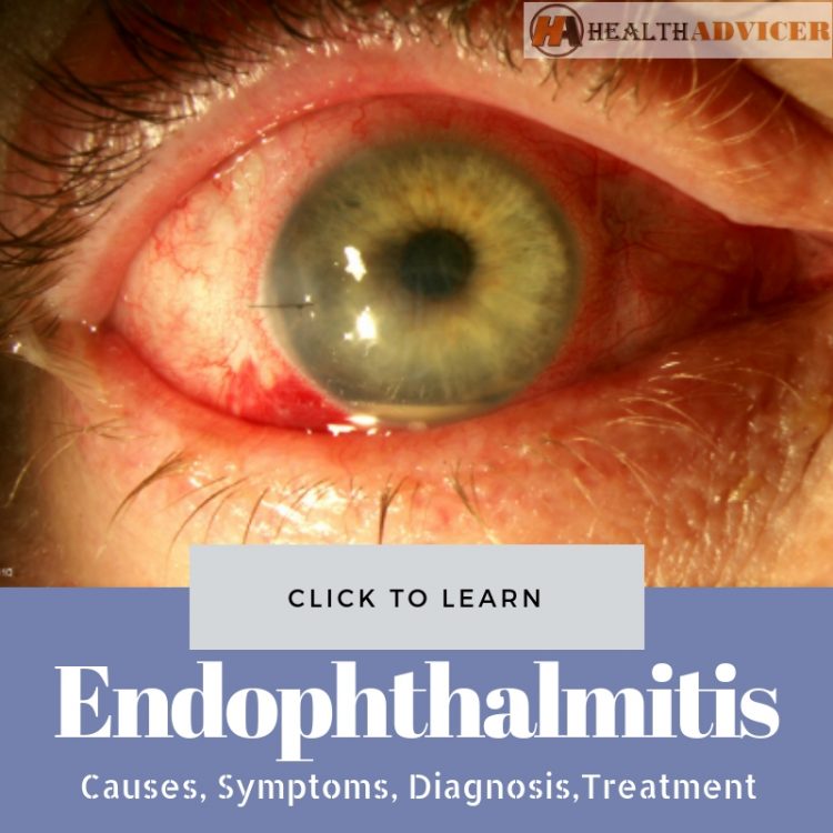Endophthalmitis Picture