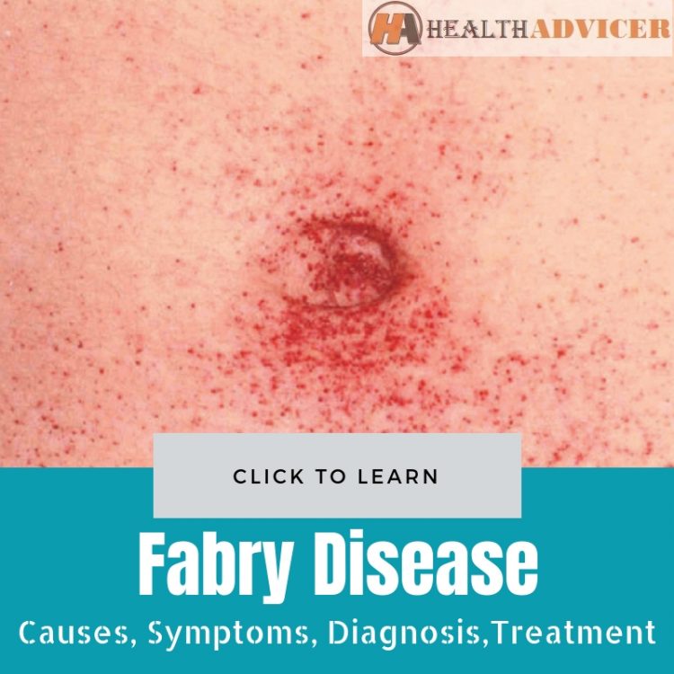 Fabry Disease Causes Treatment