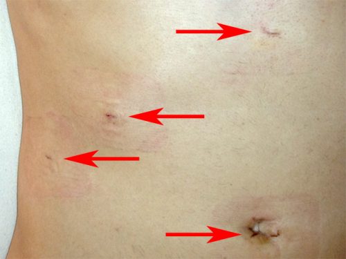 cholecystectomy scars