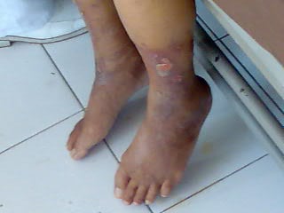 Venous Disease