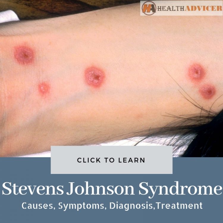 Stevens Johnson Syndrome