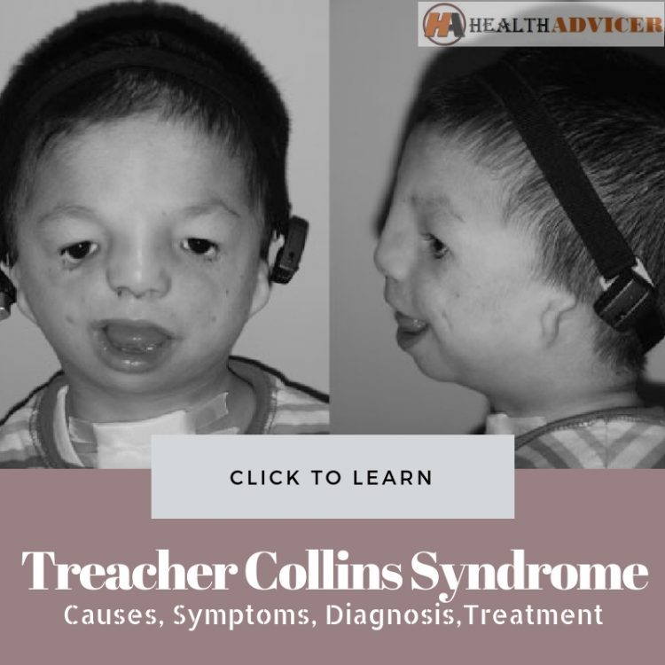 Treacher Collins Syndrome Picture