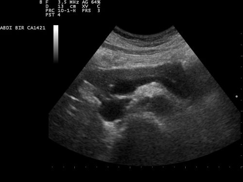 Abdominal Ultrasound