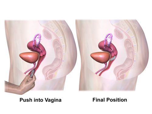 Vaginal Ring