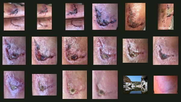 Wound Healing Stages