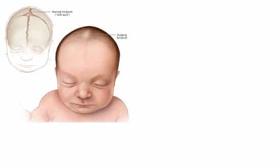 Signs In Young Children Due To Encephalitis