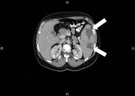 Splenic Infarction