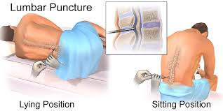 Spinal Tap/ Lumbar Puncture