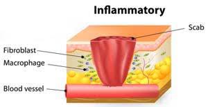 Second Phase Of Wound Healing Stages: Inflammatory Phase