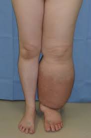 Lymphedema