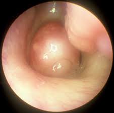 Nasal Polyps