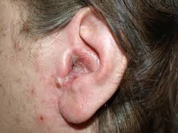 Otitis Externa