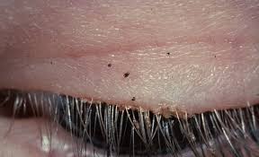 Eyelash Lice