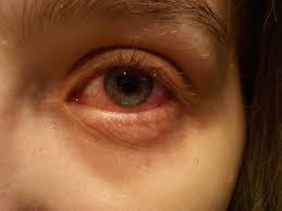 Chronic Pink Eye