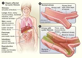 Cystic Fibrosis