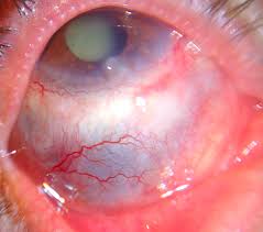 Scleritis