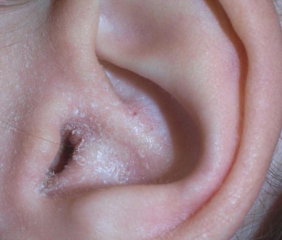 Ear Canal Dermatitis