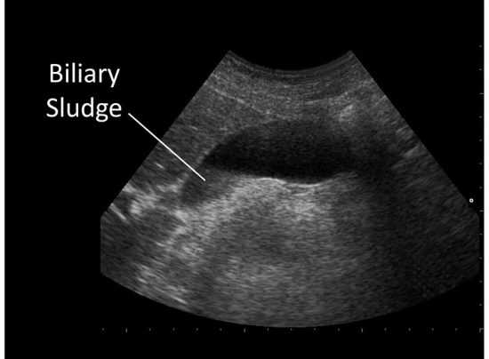 Biliary Sludge