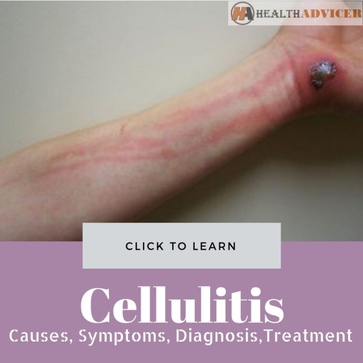 Cellulitis pictures