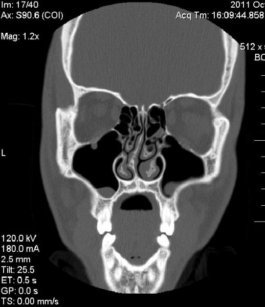 Deviated Septum