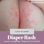 Diaper Rash Picture causes